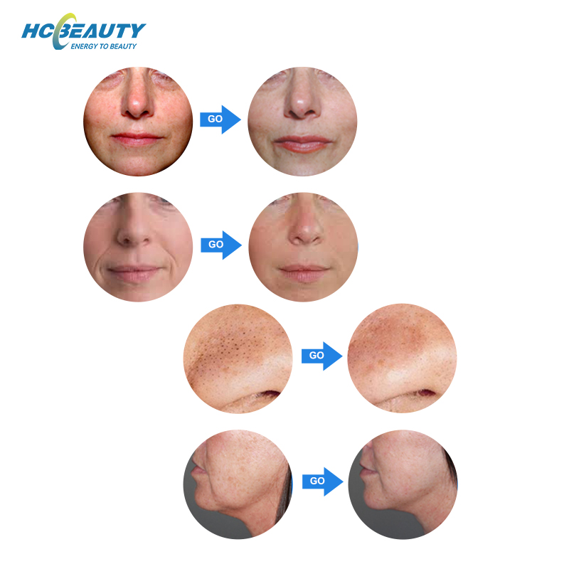 9 in 1 Skin Tightening Whitening Wrinkle Removal Deep Facial Cleaning Multifunction Oxygen Facial Machine G882A-4S