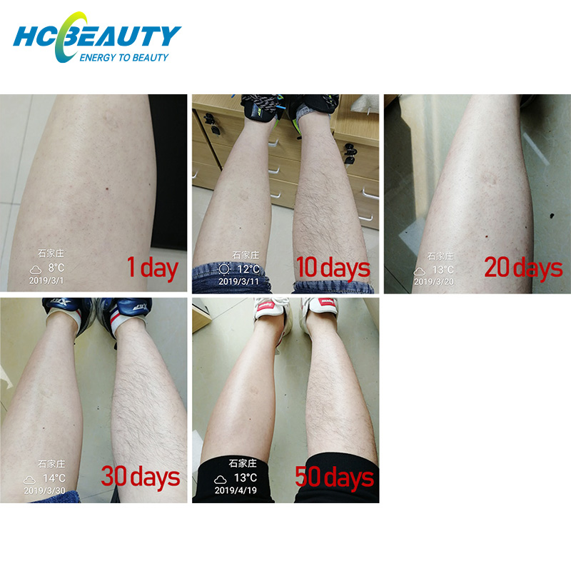 3 Wavelength Clinic Use High Power Painless Laser Hair Removal Machine